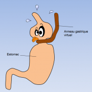 Anneau gastrique