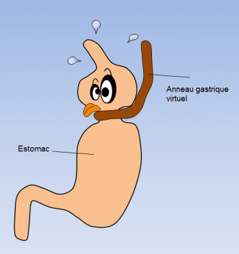 Anneau gastrique