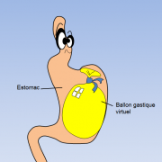 Ballon gastrique virtuel virginie pagnier la jarrie