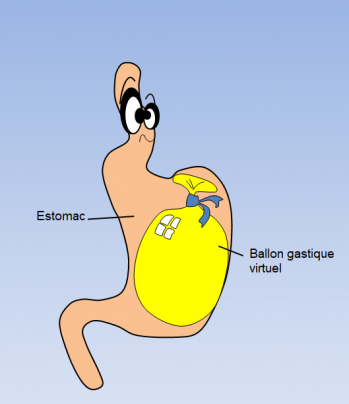 Ballon gastrique virtuel virginie pagnier la jarrie